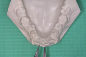 orthodontie-analyse-arcade-mesure-de-la-DDM