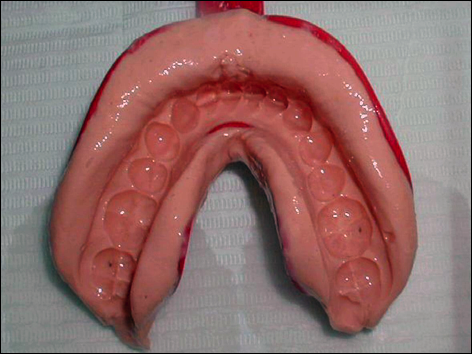 empreinte-dentaire-alginate