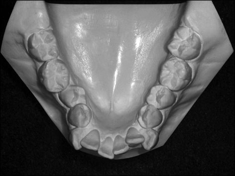 moulage-modele-orthodontique-taille-americaine-occlusal-mandibulaire