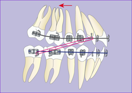 Traitement-orthodontique-multiattache-avec-extraction-4-premolaires en-7-images-phase4