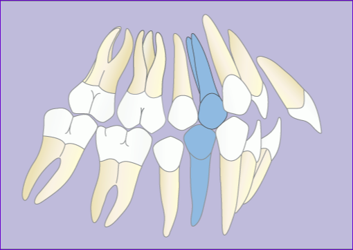Traitement-orthodontique-multiattache-avec-extraction-4-premolaires en-7-images-Avant