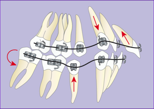 Traitement-orthodontique-multiattache-avec-extraction-4-premolaires en-7-images-phase1