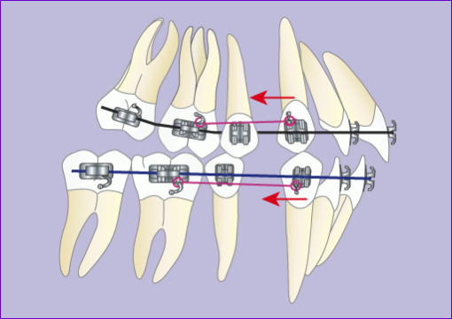 Traitement-orthodontique-multiattache-avec-extraction-4-premolaires en-7-images-phase2