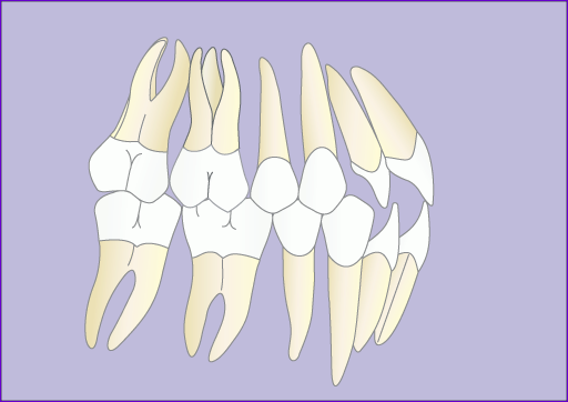 Traitement-orthodontique-multiattache-avec-extraction-4-premolaires en-7-images-final