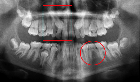Radiographie-panoramique-montrant-une-canine-maxillaire-incluse-et-une-agenesie-de-premolaire-inferieure