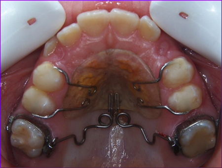 appareil orthodontique fixe: le Pendulum