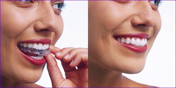 Orthodontie Invisalign: mise en place de la gouttière ou aligneur