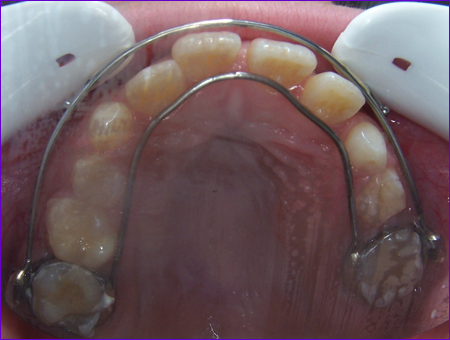 appareil orthodontique fixe:double arc utilisé avec masque facial de Delaire