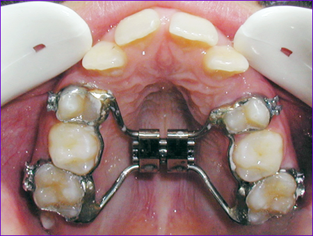 appareil orthodontique fixe:disjoncteur sur bagues