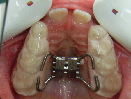 appareil orthodontique fixe disjoncteur sur gouttières