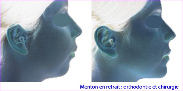 Chirurgie orthognatique:avancée mandibulaire,comparaison du profil d